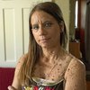 "Меня называли жабой": 45 лет женщина страдала от ужасной болезни (фото)