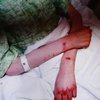 Кровавые раны на ногах и руках: мать заморила голодом падчерицу (фото)