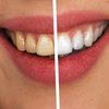 Уход за зубами: названы основные ошибки 