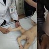 11-месячному мальчику успешно удалили третью ногу (фото) 