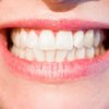 Отбеливание зубов: как добиться белоснежной улыбки