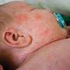 Корь в Украине: многодетная семья заболела из-за отказа от прививок