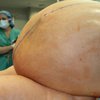 Из живота женщины извлекли 60-килограммовую опухоль (фото)