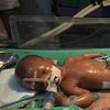 В Индии родился "пластиковый" мальчик с кожей как из воска (видео)