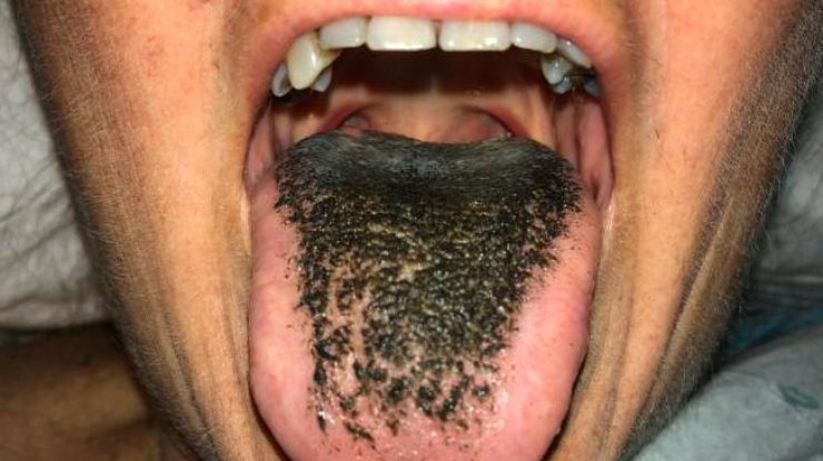 Заболевание lingua villosa nigra, или черный язык, считается крайне редким