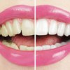 Из-за чего желтеют зубы: ответ медиков 