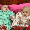 Уникальный случай: женщина родила близнецов от разных мужчин 