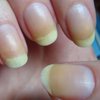 О чем говорят желтые ногти: ответ медиков