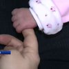 У Німеччині народилися малюки з вадами кінцівок