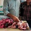 В Индии родилась девочка с четырьмя ногами и тремя руками (фото) 