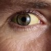 О чем сигнализируют желтые белки глаз 