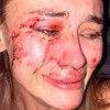Избиение модели на турецком курорте: в нападении заподозрили бойфренда