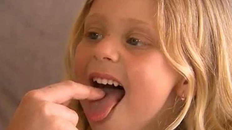 Фото: у ребенка дырка в языке от конфет / 9news.com