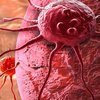 Борьба со смертью: разработана уникальная технология "убийства" рака