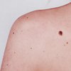 Рак кожи: первые симптомы, на которые стоит обратить внимание