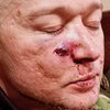 Андрей Хливнюк попал под минометный обстрел: музыкант показал ранение 