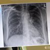 Лікарі назвали два основні симптоми раку легень