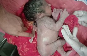 В Індії дитина народилася з третьою рукою в неочікуваному місці (фото)