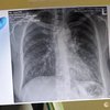 У Британії почалися випробування вакцини від раку легень