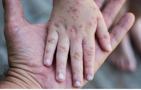 У Києві зафіксовано спалах кору: як не підчепити хворобу