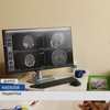 Унікальна операція: жінці видалили пухлини в мозку при свідомості