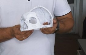 Збирають черепи й кістки: як у Мукачеві виготовляють імпланти для бійців
