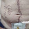 Захиснику видалять напис "слава росії", який випалили в полоні
