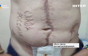Захиснику видалять напис "слава росії", який випалили в полоні