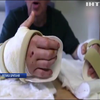 Британець повертається до життя після унікальної пересадки рук (відео)
