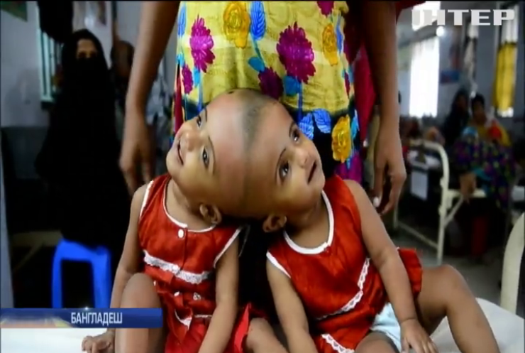 У Бангладеш готують до операції "сіамських" близнючок