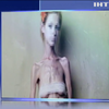 Смерть від анорексії: дівчина з Черкас вкоротила собі віку голодуванням