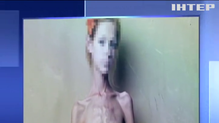Смерть від анорексії: дівчина з Черкас вкоротила собі віку голодуванням