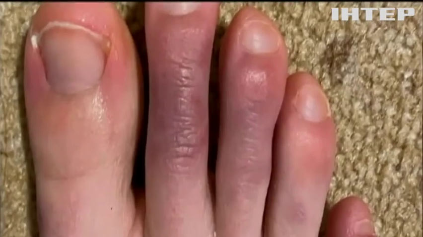 Набряк пальців: лікарі виявили ще один симптом COVID-19