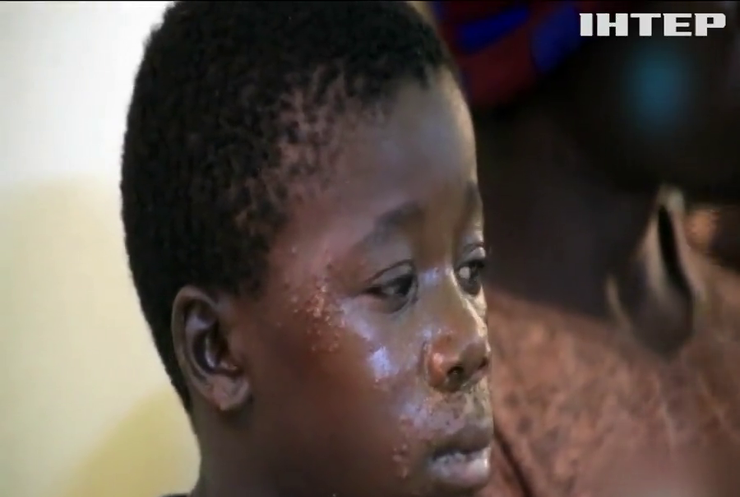 У Сенегалі рибалки заразилися невідомою хворобою