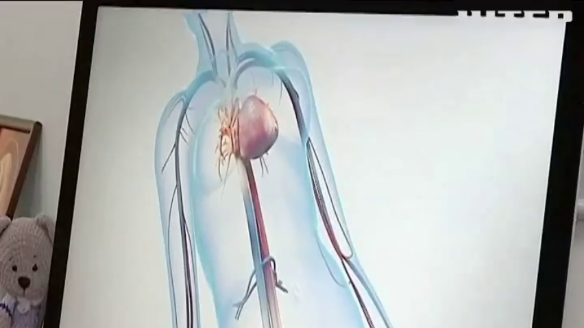 В Черкасах жінці замінили серцевий клапан на штучний