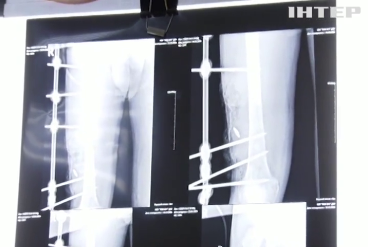 Медики з Дніпра врятували кінцівку бійцю ЗСУ попри невтішні прогнози