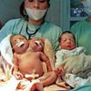 В Аргентине родились уникальные сиамские близнецы