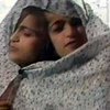 Сингапур: взрослые сиамские близнецы не перенесли операцию по разделению