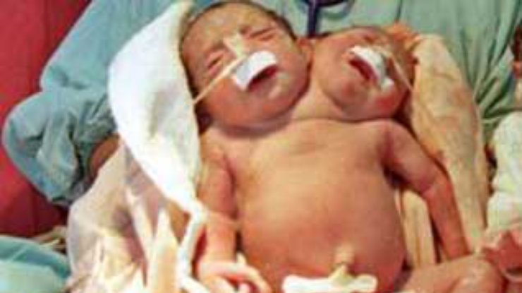 В Аргентине умерли "сиамские близнецы"