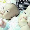 Сингапурские медики проведут новую операцию по разъединению сиамских близнецов
