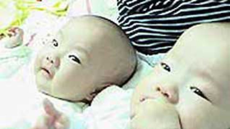 Сингапурские медики проведут новую операцию по разъединению сиамских близнецов