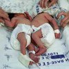 Бразильские врачи разделили сиамских близнецов