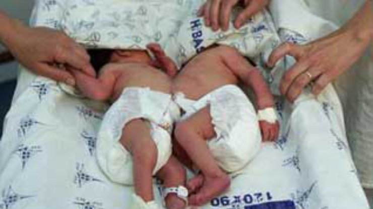 Бразильские врачи разделили сиамских близнецов