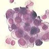 Обнаружено вещество, обеспечивающее подвижность раковых клеток