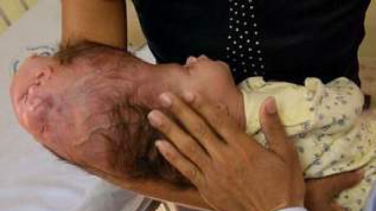 В Доминиканской республике будет проведена операция девочке, родившейся c двумя головами