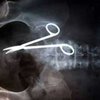 Австралийские хирурги забыли ножницы в животе пациентки