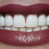 Британские стоматологи научились выращивать зубы