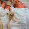 В США родились уникальные близнецы