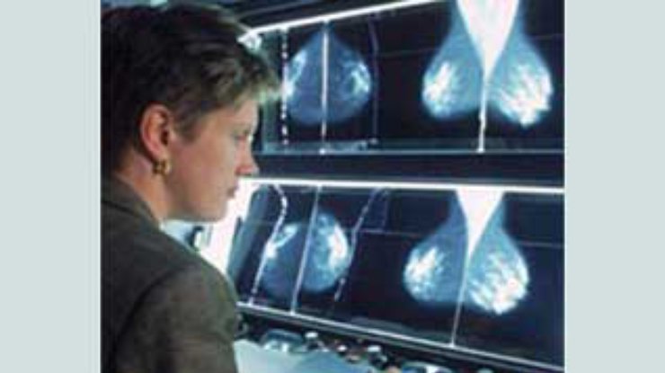Маммография обманывает каждую пятую женщину
