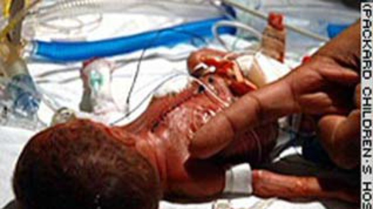 Американский хирург сделал операцию на открытом сердце 700-грамовому ребенку